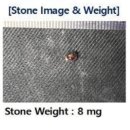 경수 | 신장결석제거 연성요관경수술 후기, 통증