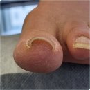 고려튼튼의원 | 의정부내성발톱 효과 탁월한 관리 후기 고려마디튼튼