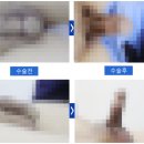 팽창형보형물/굴곡형임플란트? 17년차 전문의가 정리한 &#39;차이점&#39;