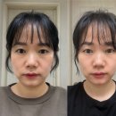 인천 송도 피부과 고주파 리프팅 텐써마 후기