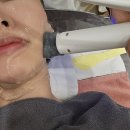 삼성동-7 | 울써마지의 진화, 통증 없이 V라인까지 잡아주는 XERF 세르프프리미엄 리프팅 7일차 후기 삼성동리프팅