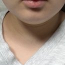 365mc 이중턱 브이올렛 DCA 밉살주사 2회차 후기 :: 무료 재시술 받는법 통증 붓기 변화 가격