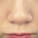 챔코 | 코조각주사 후기(1회차)