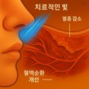 비염 면역치료 원리 효과 치료핵심 후기공유