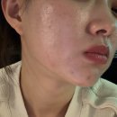 아셀 | 최근 핫한 스킨부스터 쥬브아셀 내돈내산 후기 강남피부과