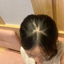 기린성형외과의원 | 강남성형외과 '기린성형외과' 정수리 미녹시딜 탈모주사 3회차 후기(Before&amp;After)