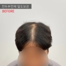 레이븐스칼프 이미지