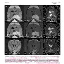 Atypical and malignant canine intracranial meningioma에서의 ADC value 비교 이미지