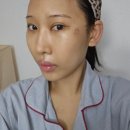 압구정 | 압구정 실리프팅 후기 부작용부터 효과까지, 솔직후기 (전후사진)