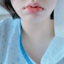 BH대학효요양병원 | [편도제거수술]30대 여성의 대학병원 편도절제술 후기,,,(고통의 2주)