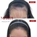 헤어라인 이미지