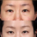 르미엘성형외과의원 | 앙코르 눈밑지, 왜 결과가 다를 수밖에 없을까요?