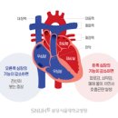 심부전 원인 증상 진단 치료 경과 수술 주의사항 우심실 좌심실 부전 이미지