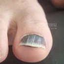 광주 문제성발톱 멍든엄지발톱 티눈제거 동시 해결한 후기