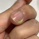 군포 지샘 병원에서 조갑주위염으로 치료 과정 및 후기