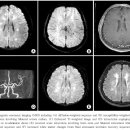 칼시뉴린 억제제에 의하여 유발된 다발성 뇌경색 이미지