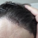 주식회사 빈 | 헤어타투 제품 빈머리 두피타투 리얼 사용후기