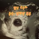 본죽 담양점 | <임신 6주차>증상, 성장, 서브병원 꿀팁, 입덧약 복용후기