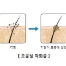 모공 각화증 (Keratosis pilaris) 이미지