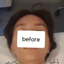 두근두근 뽑기샵 | [하남미사피부관리] 차원이다른 고급 울트라4D 애프터확실한 얼굴경락 (before/after 비교리얼후기)
