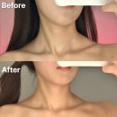 바른마음한의원 마곡발산점 | 마곡 승모근관리 신부관리 등 후기 스완드에스테틱 발산점 추천