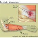 Tendinitis(건염),tendinosis(건병증) 이미지