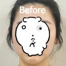 경주 웨딩관리 오엔에스테틱 웨딩 윤곽 솔직 후기(승모근+비대칭 맞춤 케어)