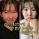 팔자주름고민해결 천안 불당동 온리영의원 팔자필러후기