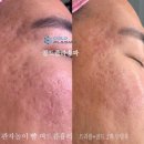 콜드 플라 송파 이미지