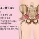 이상근증후군 치료좌골 절흔구글이미지에서검색 이미지