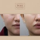 로사의원 | 다이어트 피부 생기 대박! ECM 스킨부스터 셀르디엠·리투오 로사원장 리얼후기