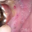 안면기공소 | 인천 70대임플란트, 턱관절치료와 치주관리 병행으로 완성한 고난도 전악 재건