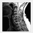 경추 추간판탈출증 이미지