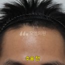 중앙헤어라인 이미지