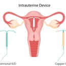 하산부인과의원 | 논현동산부인과, 수술없이 점막하근종 미레나 치료 하고싶다면
