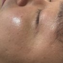 헤이민뷰티스튜디오 | 대구 주근깨 제거 전후 내돈내산 찐후기 헤이민뷰티스튜디오