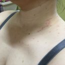 로이브로우아카데미 | 대구 쥐젖 / 편평사마귀 / 사마귀점 제거 (로이브로우 아카데미)