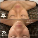 향남피부관리 이지에스테틱 예비신부 웨딩윤곽관리 솔직후기