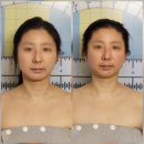 바디스타 | 화정 엘트리움스킨앤바디 스타리프팅 후기, 얼굴선이 진짜 정리됐다