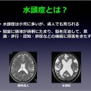 정상압 수두증의 진단, 불안 = 답하는 이. 鮫島直之(사메지마 나오유키, さめじま なおゆき)부장(도쿄 교사이 병원 東京共済病院, 뇌신경외과) 이미지