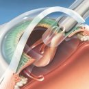 [봄의약속안과]인공수정체(IOL/intraocular lens)란 무엇입니까?(강동구 백내장,백내장수술) 이미지