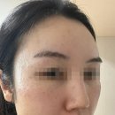 연례 행사가 될 편평사마귀 제거(feat.제대로 된 피부과찾기)