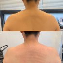 바디빈플러스 | 천안 바디관리, 천안 웨딩관리 뉴에스테틱에서 에어바디 승모근관리 받고 얼굴라인까지 예뻐진 후기!
