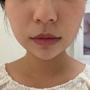 2721 | 여의도피부과 슈링크유니버스 300샷 솔직후기 내돈내산 추천(경과있음)