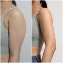 팻맨주 | 팔 지방추출주사 vs 팔 지방분해주사 비교｜팔뚝살 주사 6주차 효과 후기