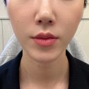 [원더걸_뷰티]리부팅의원 입술필러 후기 (슈퍼팝 페스티벌 인생샷 기록)