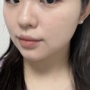 스타벅스커피 명동입구 | 명동 을지로입구역 피부과 온다리프팅 5만줄, LDM&amp;비타민 수액까지(외국인 피부과 추천)