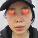 (주)하나수지 | 용인 수지 리프팅 피부과 이래비티 찐 시술 후기