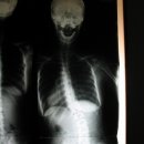 척추측만증 (Scoliosis)과 허리디스크 성공사례...SNPE 바른자세,척추교정운동수련 이미지