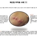 매선침 부작용에 대하여[1] 이미지